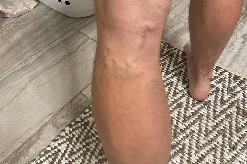 najbolji gel za proširene vene